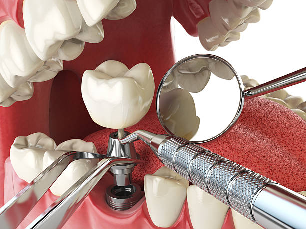 Best Emergency Root Canal Treatment in Harrisburg, OR